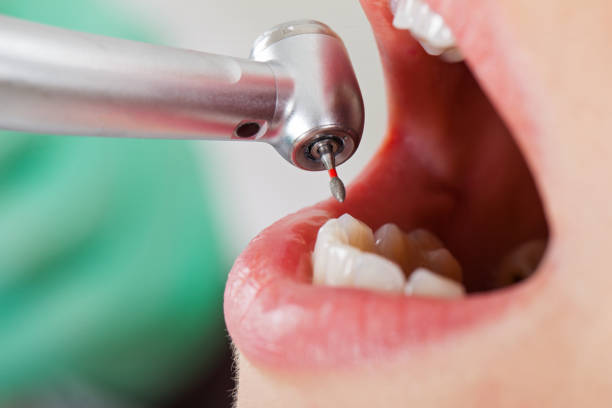 Best Emergency Dentist for Lost Fillings or Crowns in Sunray, TX